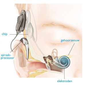 Doorsnede oor met processor, spoel en implantaat