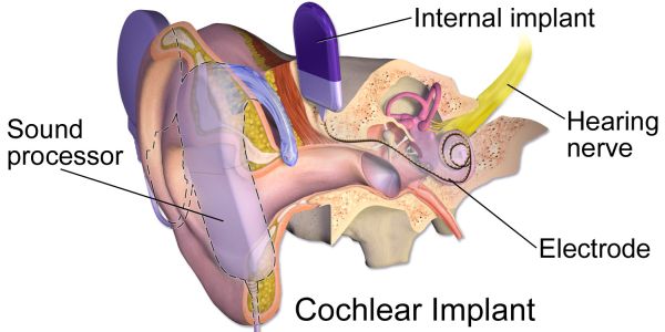 Doorsnede van het oor met cochleair implantaat